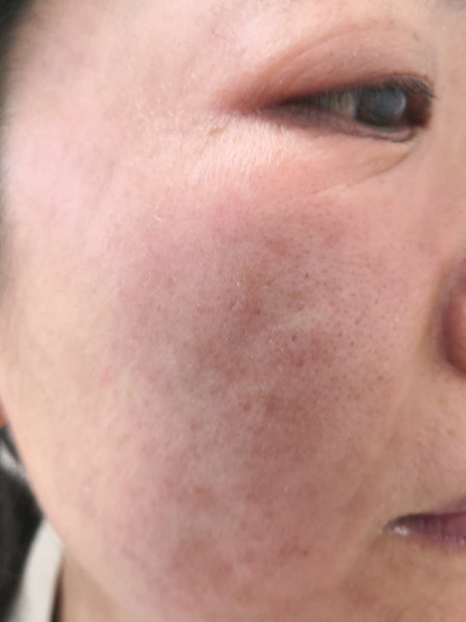 过敏#使用化妆品过敏的这么多是为什么?#解决皮肤问题专注皮肤美容