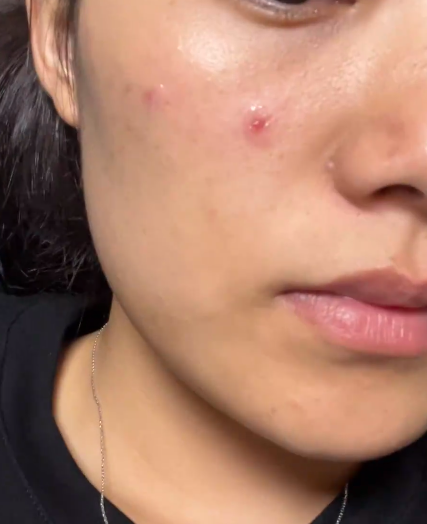 痘痘破了要马上处理,先消毒再用药,同时保护好伤口别碰水