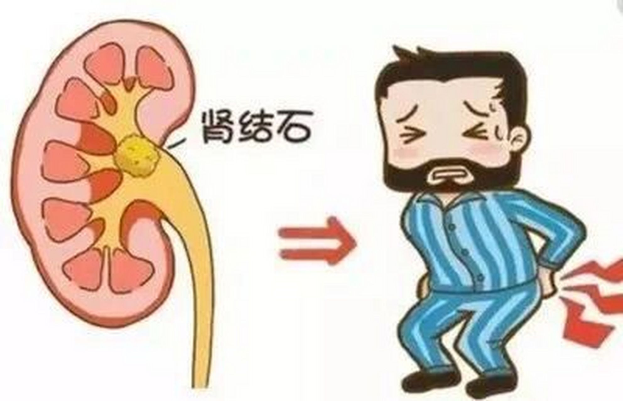 一个自己判断是否有肾结石的办法 肾结石疼起来是要人命的,那怎么自我