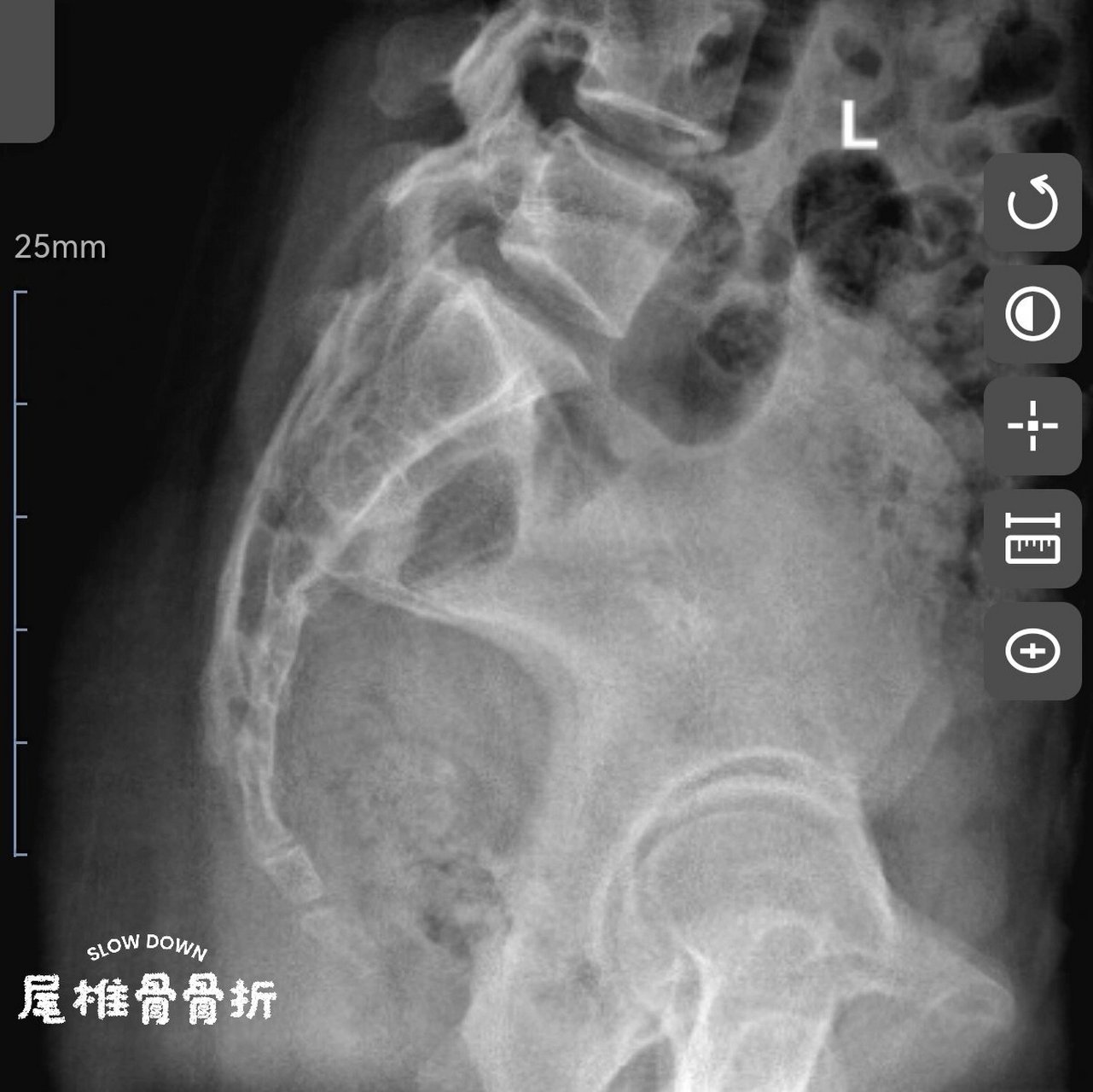 骶尾椎正侧位x线图图片