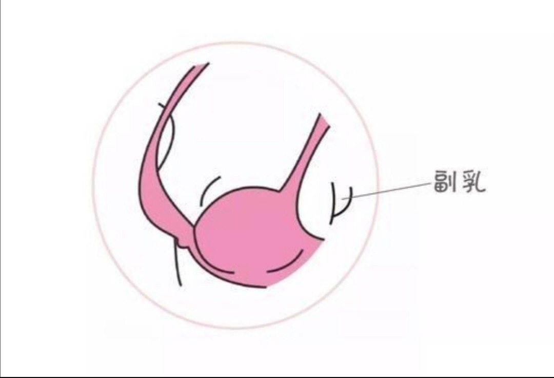 副乳会遗传吗图片