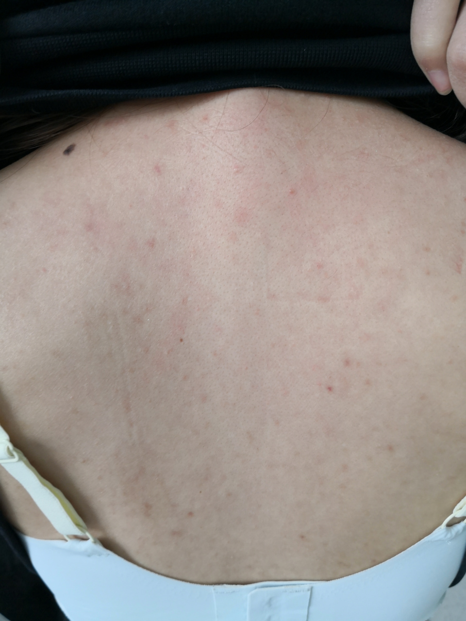 面部痤疮和前胸后背毛囊炎症状,治疗一段时间后,前胸后背毛囊炎症状