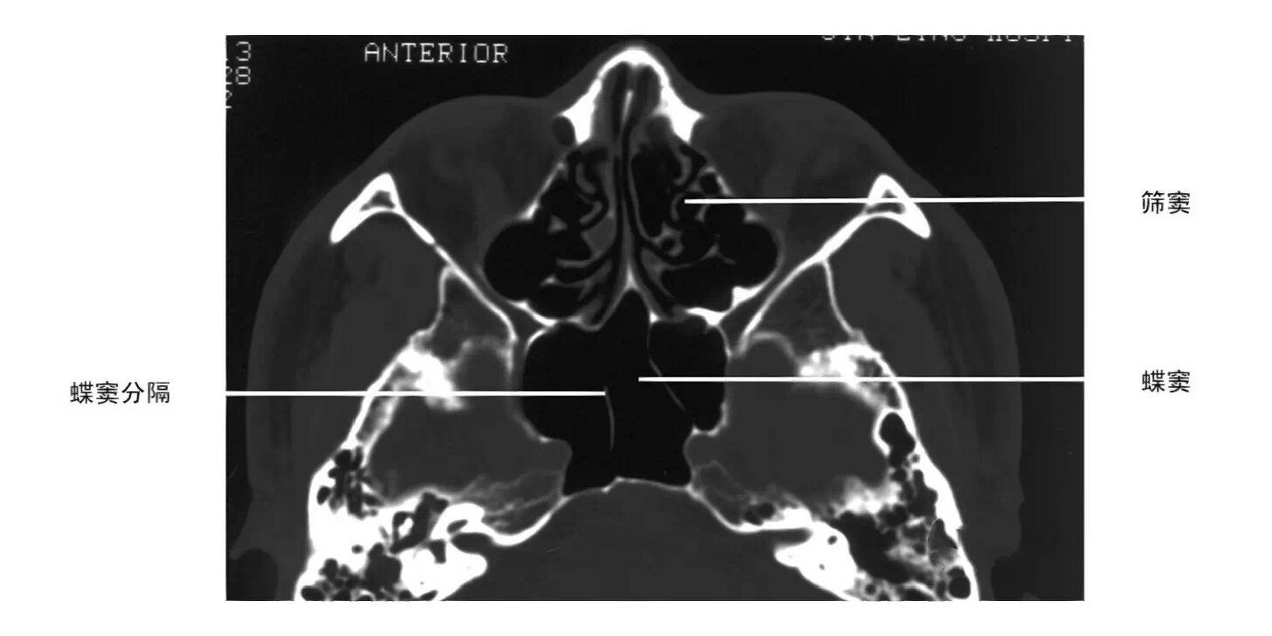 副鼻窦图片大全 解剖图片