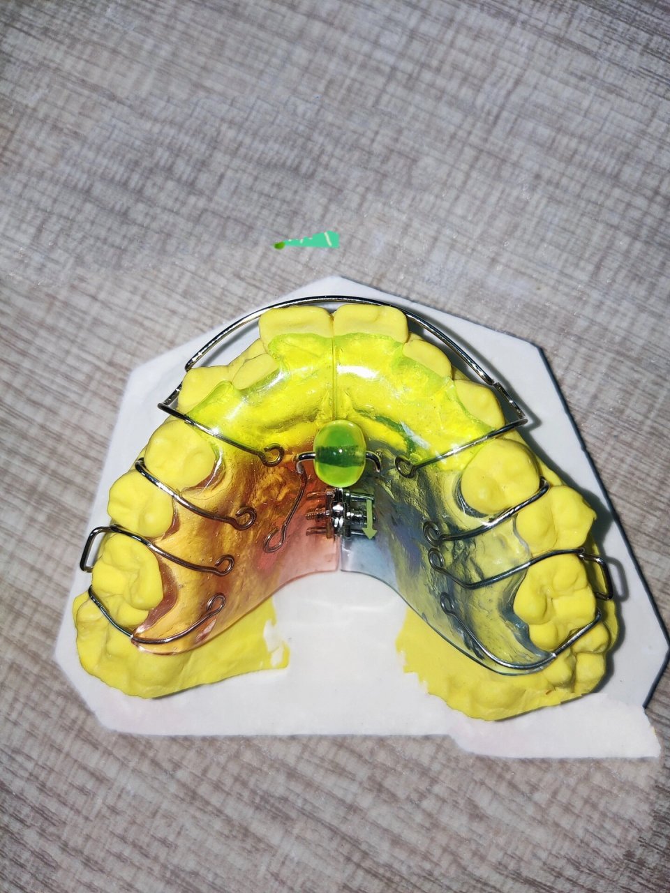 儿牙早矫——螺旋扩弓器6015 扩弓器有扩张牙弓的作用,扩弓器上有