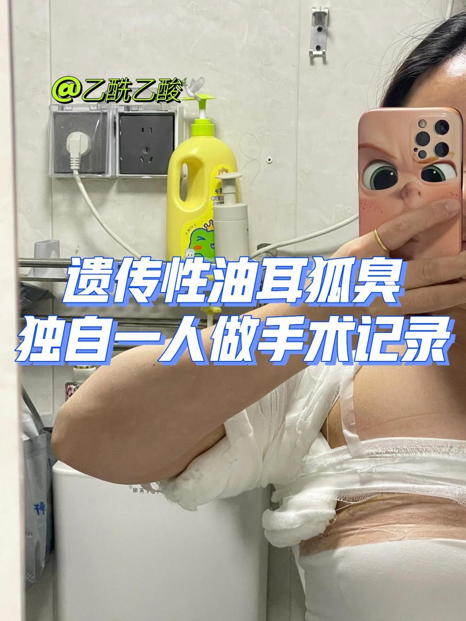 遗传性油耳狐臭|独自一人做手术记录95 95今年想了很久,还是把