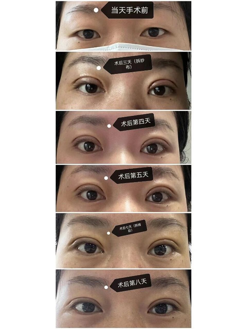 我是上眼皮比较松弛,眼尾有些下垂,选择的是全切,医生是西京医院的