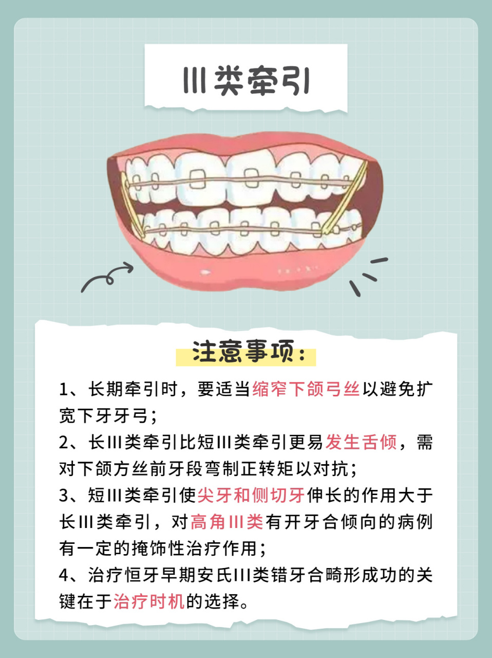 正畸|挂三类牵引的注意事项 Ⅲ类牵引——常用于安氏Ⅲ类错颌矫治.