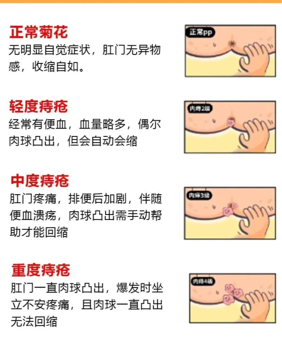 健康的肛门是肛管末端的一个前后纵行的裂孔