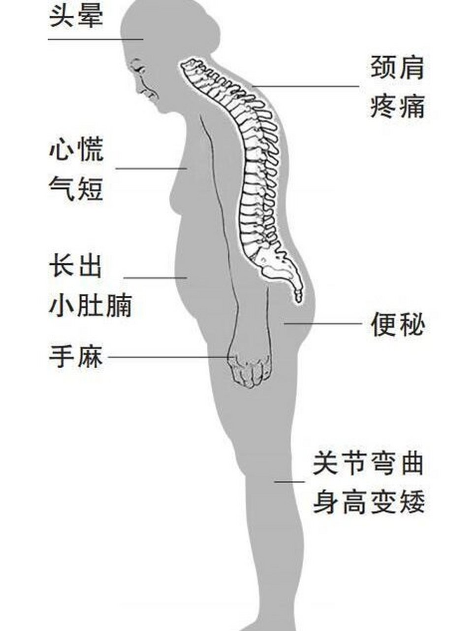 圆肩驼背的危害图片