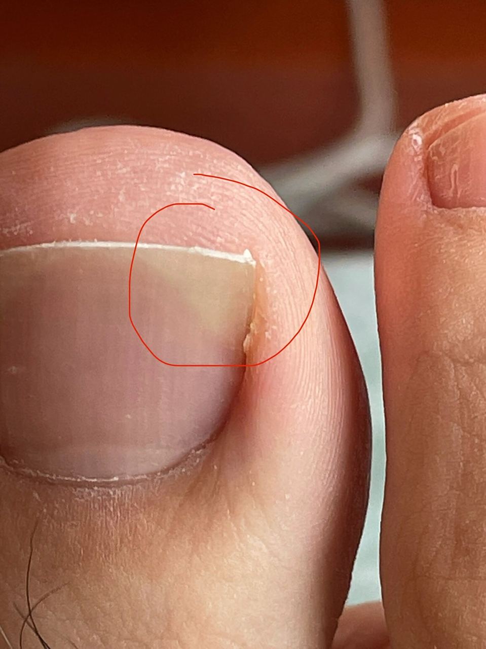 大脚趾指甲外侧上方发白 两个脚还是对称着长着,家人们有谁知道这是