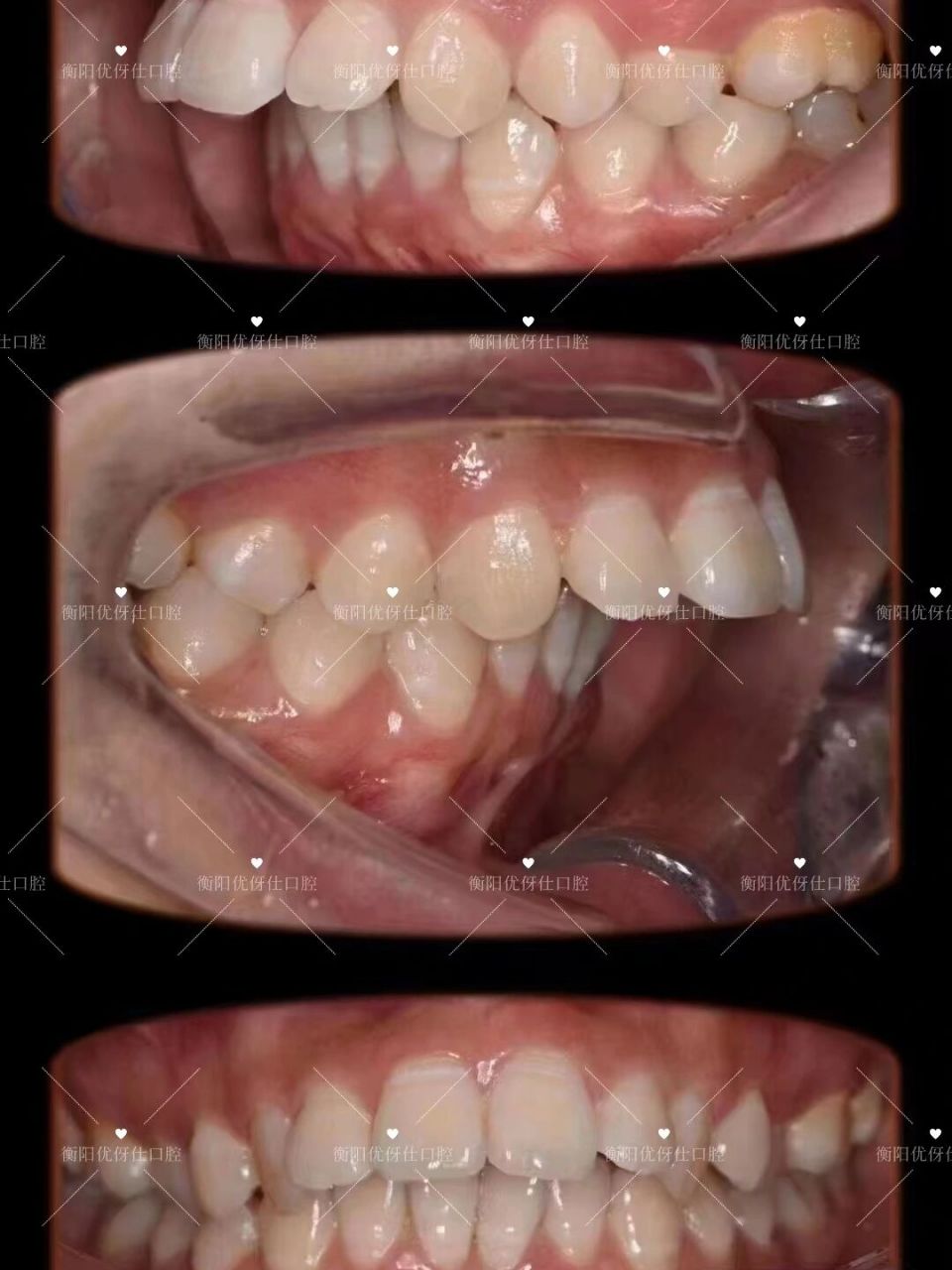 牙齿前突正畸2年后效果对比图 衡阳优伢仕口腔正畸案例分享 67上颌