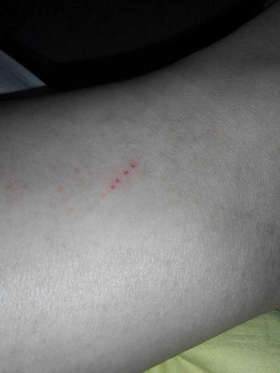 如何分辨狗狗的抓痕还是其他锋利物的割痕 很多家庭有狗狗也有小孩,很