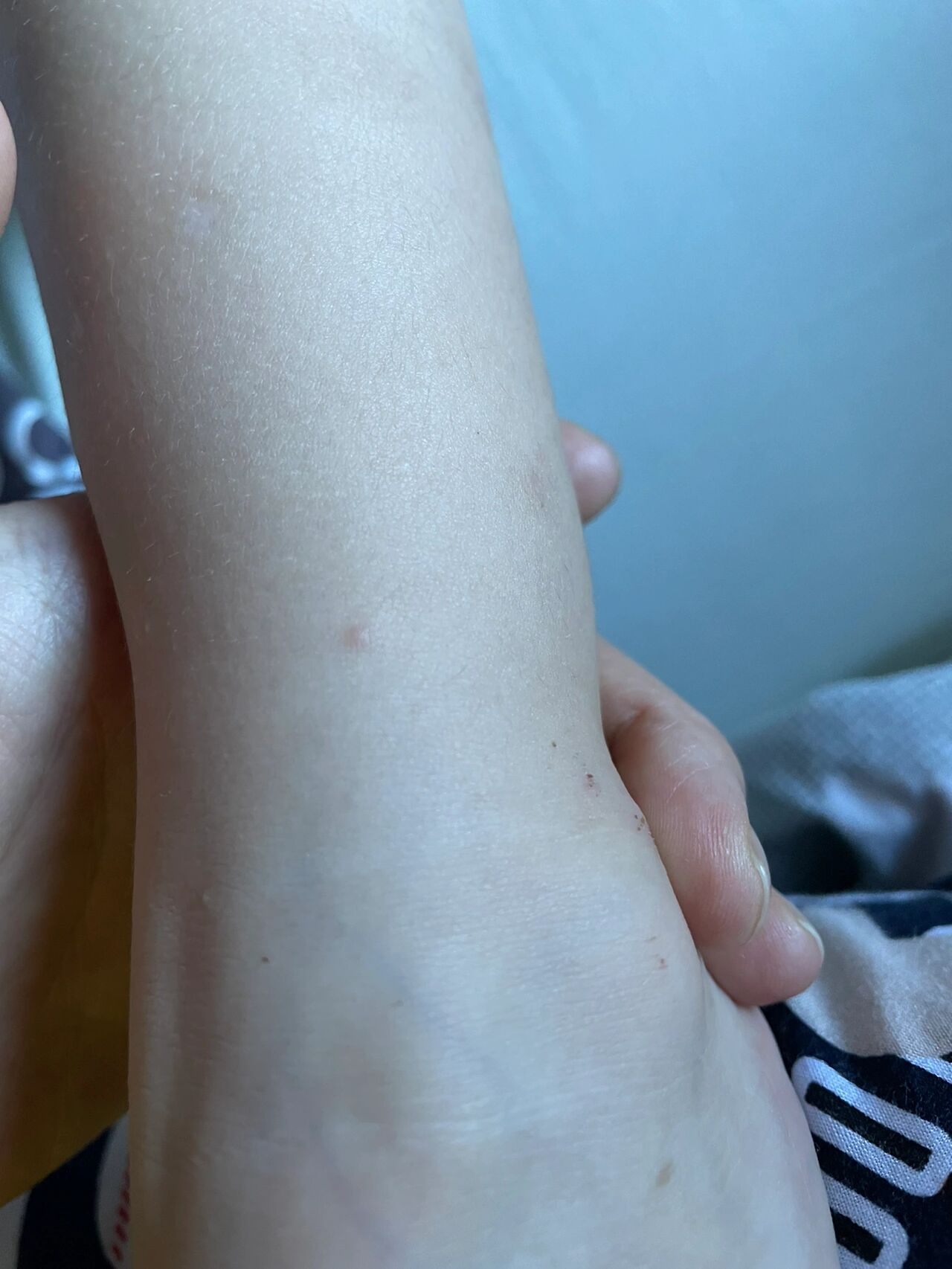 沙土性皮炎是这样的吗?还没去医院,各位宝妈帮忙看看是这样的吗?