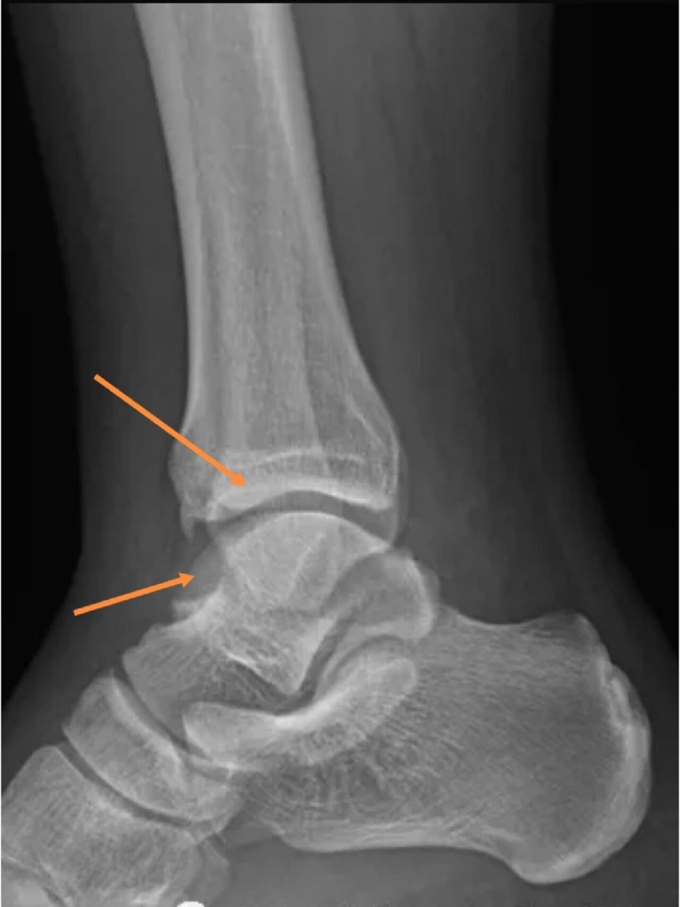 如何拍出标准的踝关节正侧位 我们先看一张较为标准的踝关节正文,看