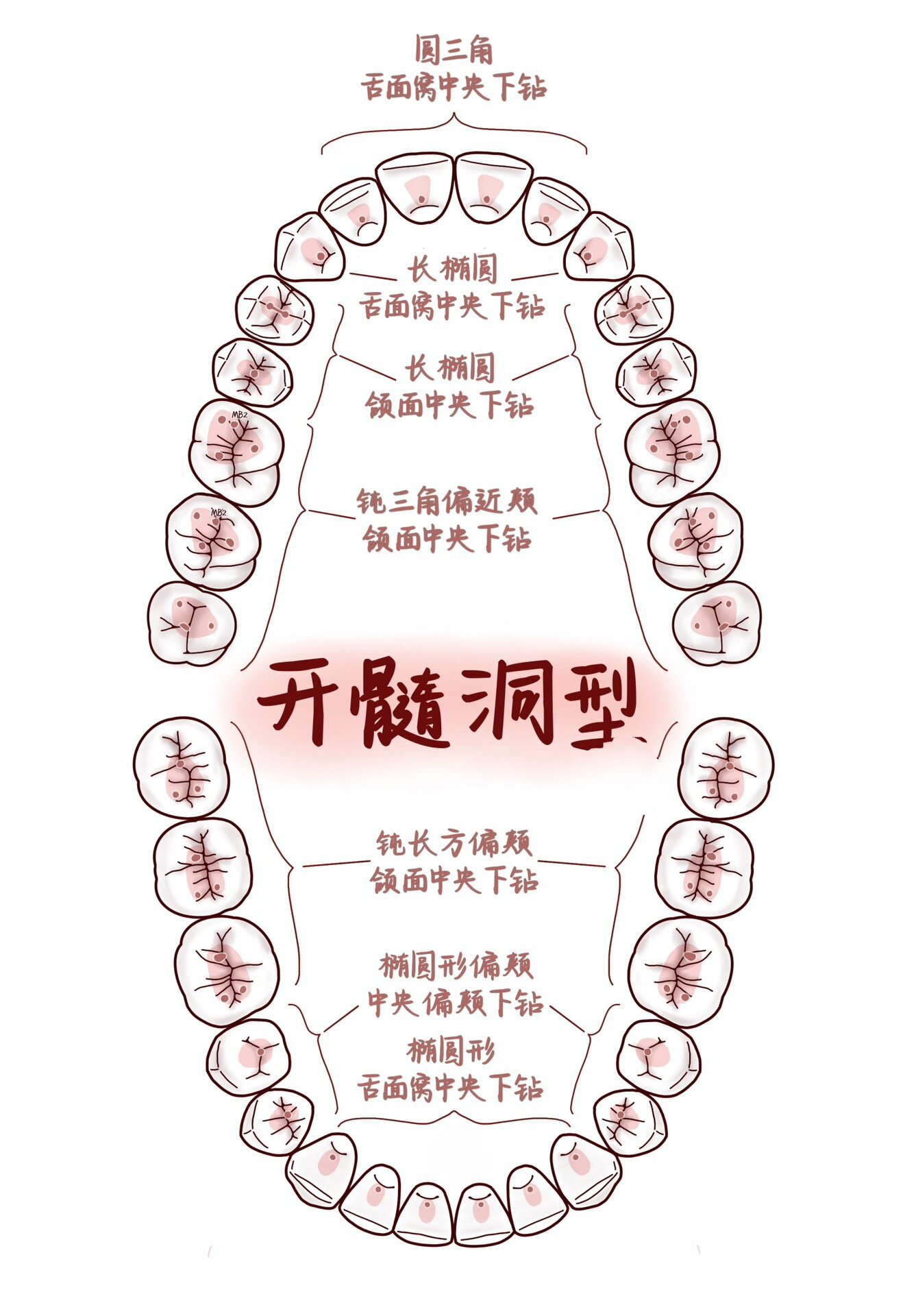 上颌侧切牙开髓位置图片