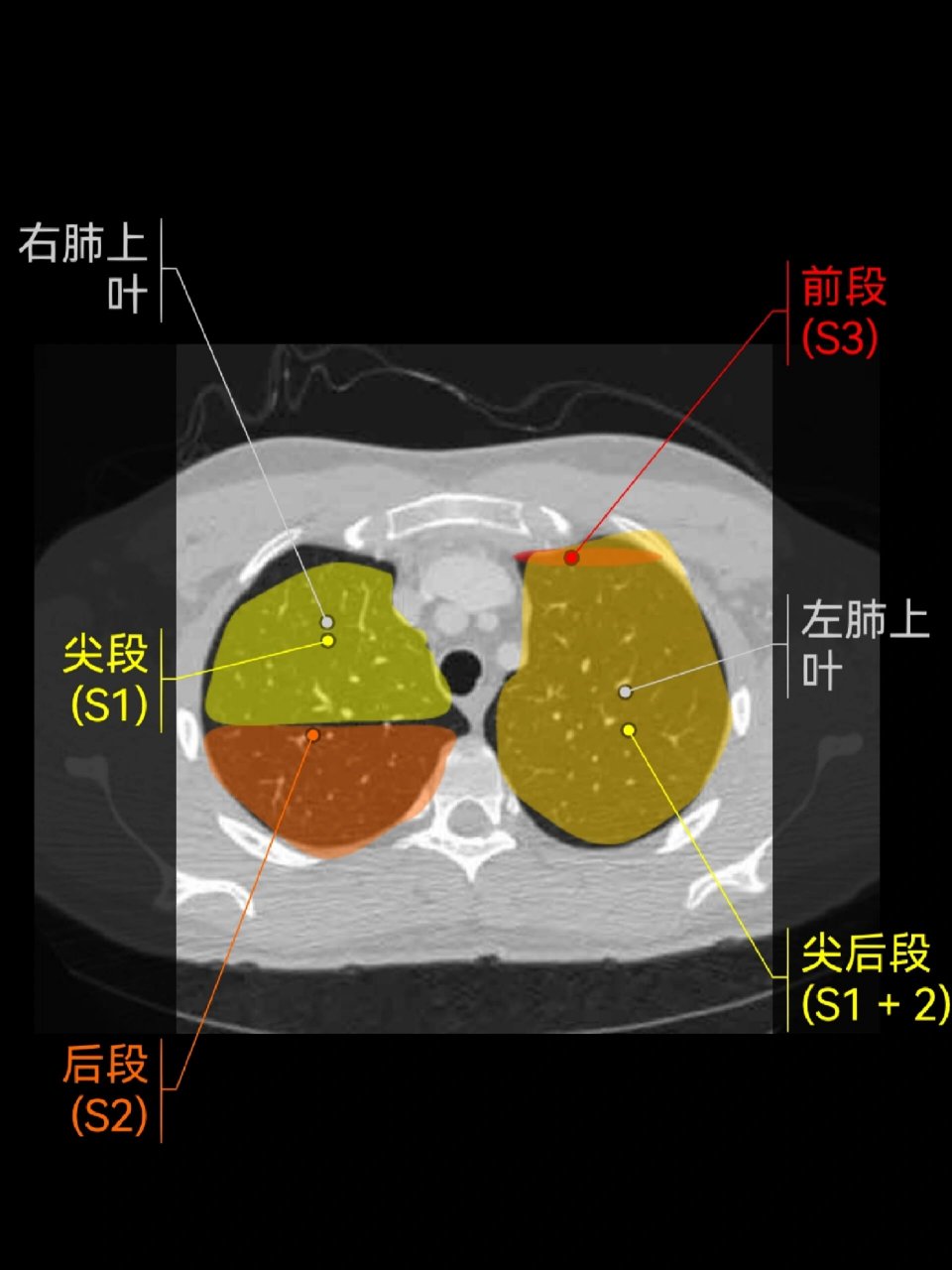 肺的ct分段(高清)|影像学习app 复习基础知识 	 右肺 上叶:s1:尖段;s2