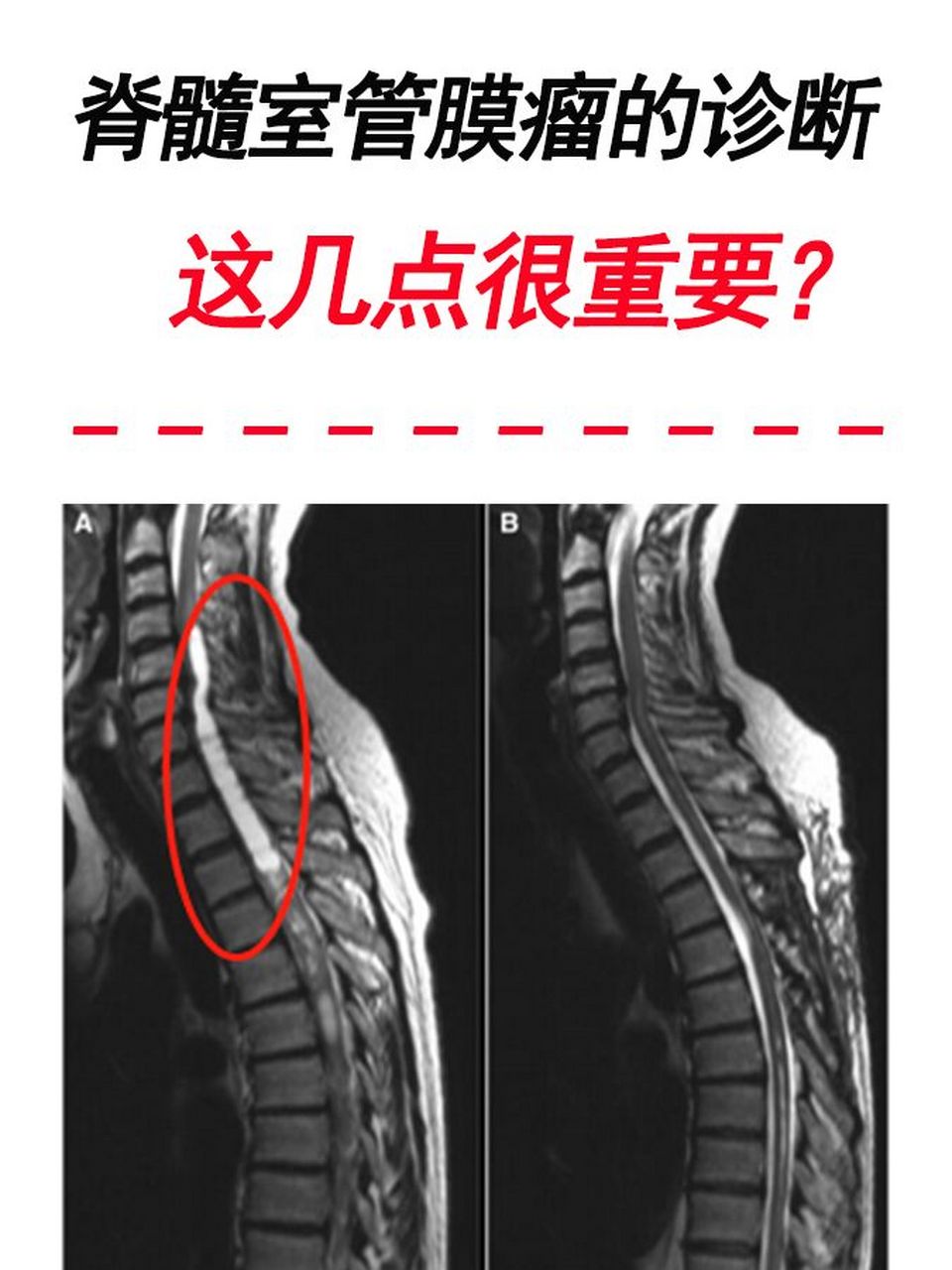 脊髓肿瘤
