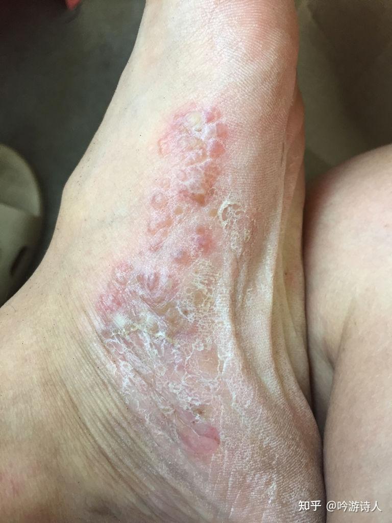 你们的水泡型脚气是怎么治好的求分享经验