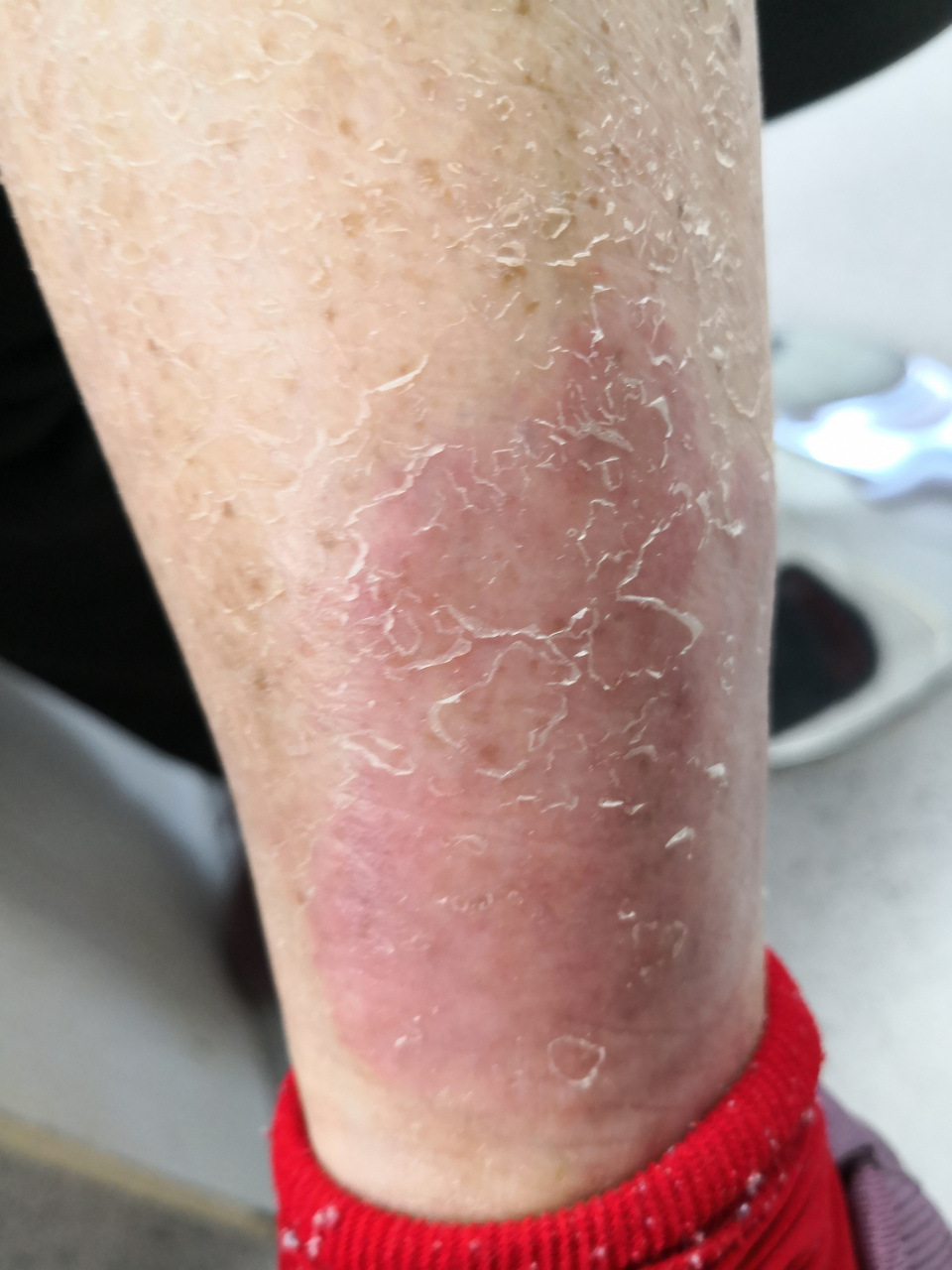 银屑病患者使用罗红霉素胶囊口服后出现过敏症状.