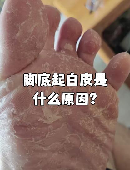 脚底起白皮最常见的原因是出汗多