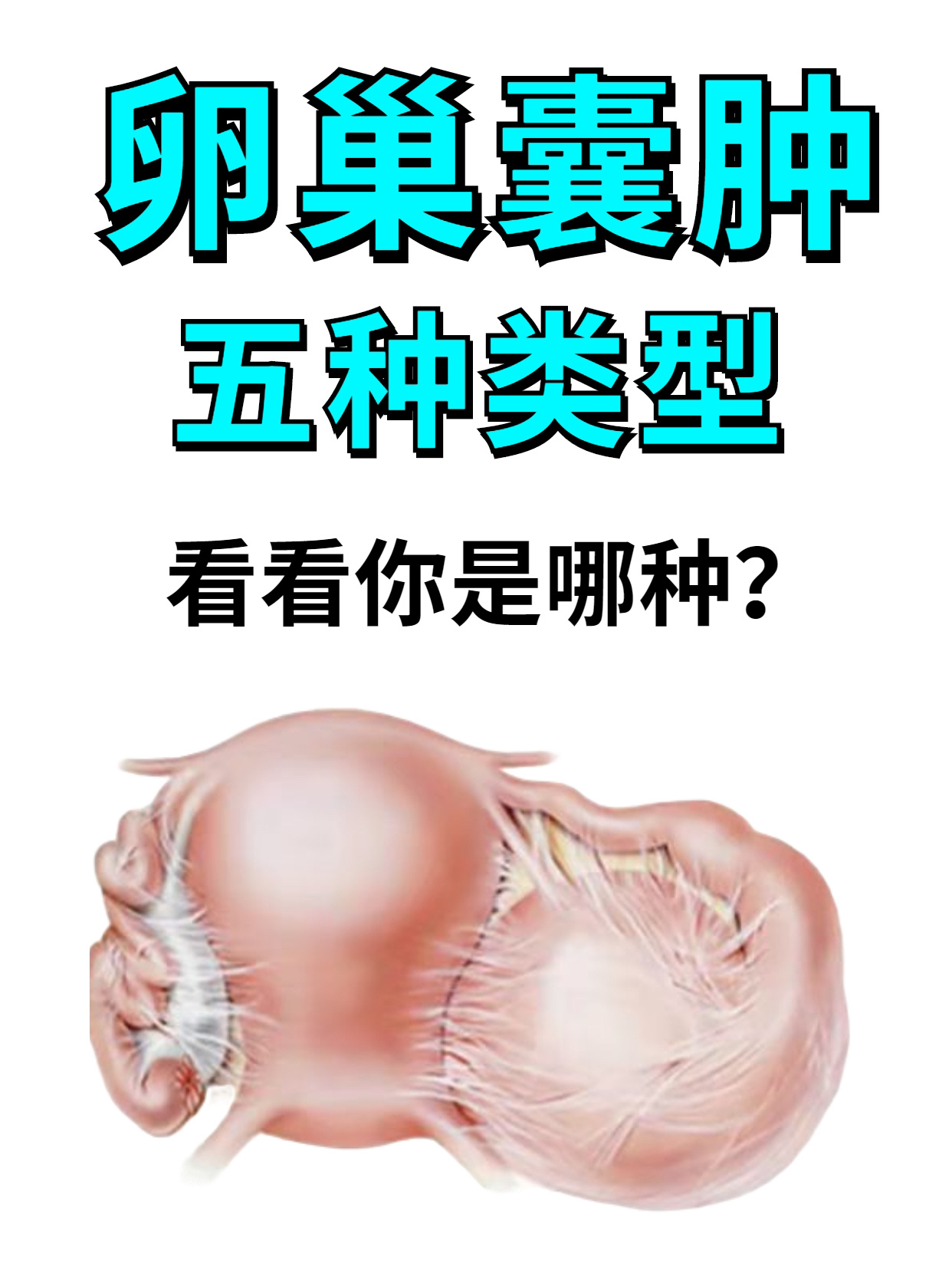 卵巢囊肿五种类型,看看你是哪种 生理性囊肿,最常见的卵巢囊肿,一般