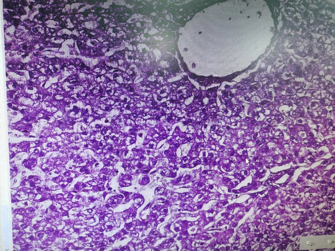 医学实验课Ⅰ病理学实验之肝细胞水肿 这是一张肝细胞水肿的he染色