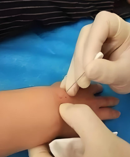 腱鞘炎患者做完小针刀怎么还疼?