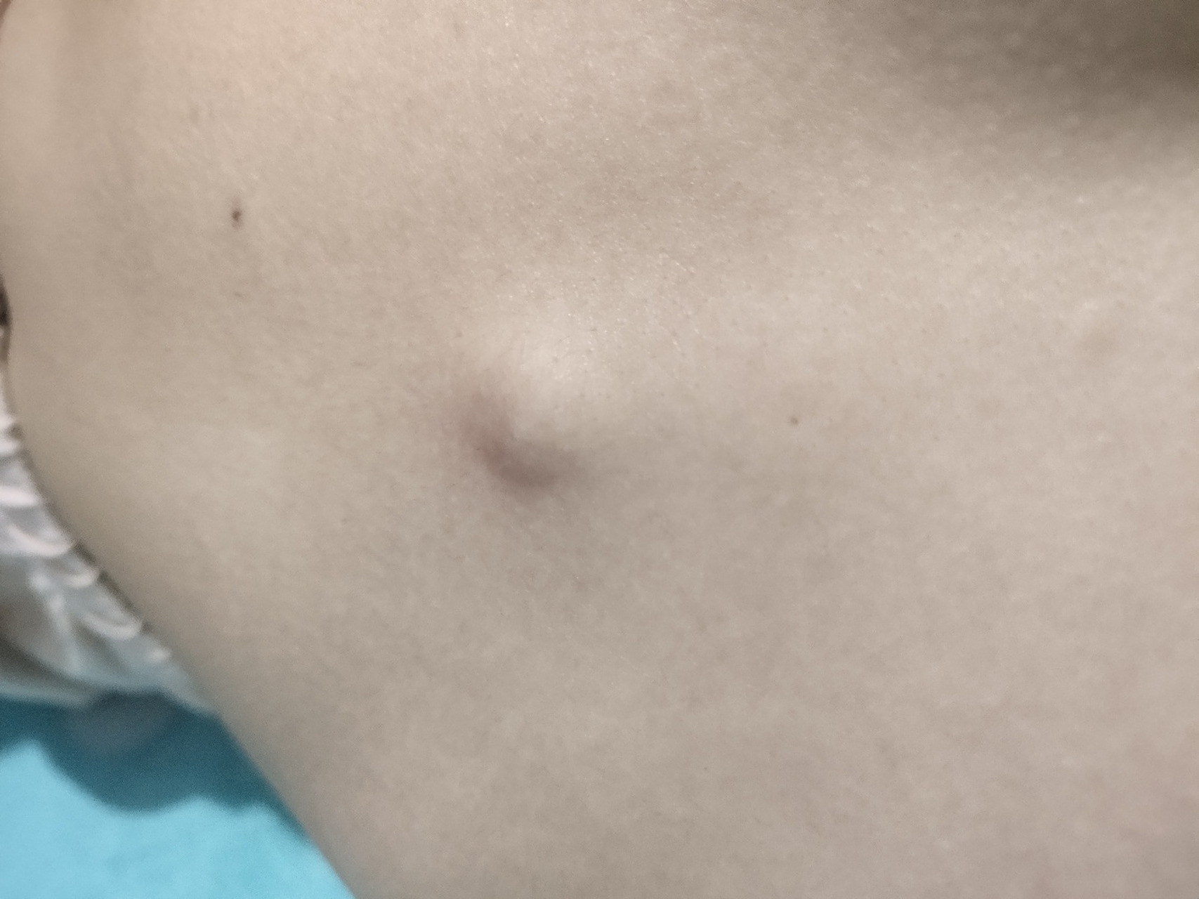 皮脂腺囊肿 挤黑头把自己挤出了内伤 3月30号晚上躺床上,发现自己肚皮