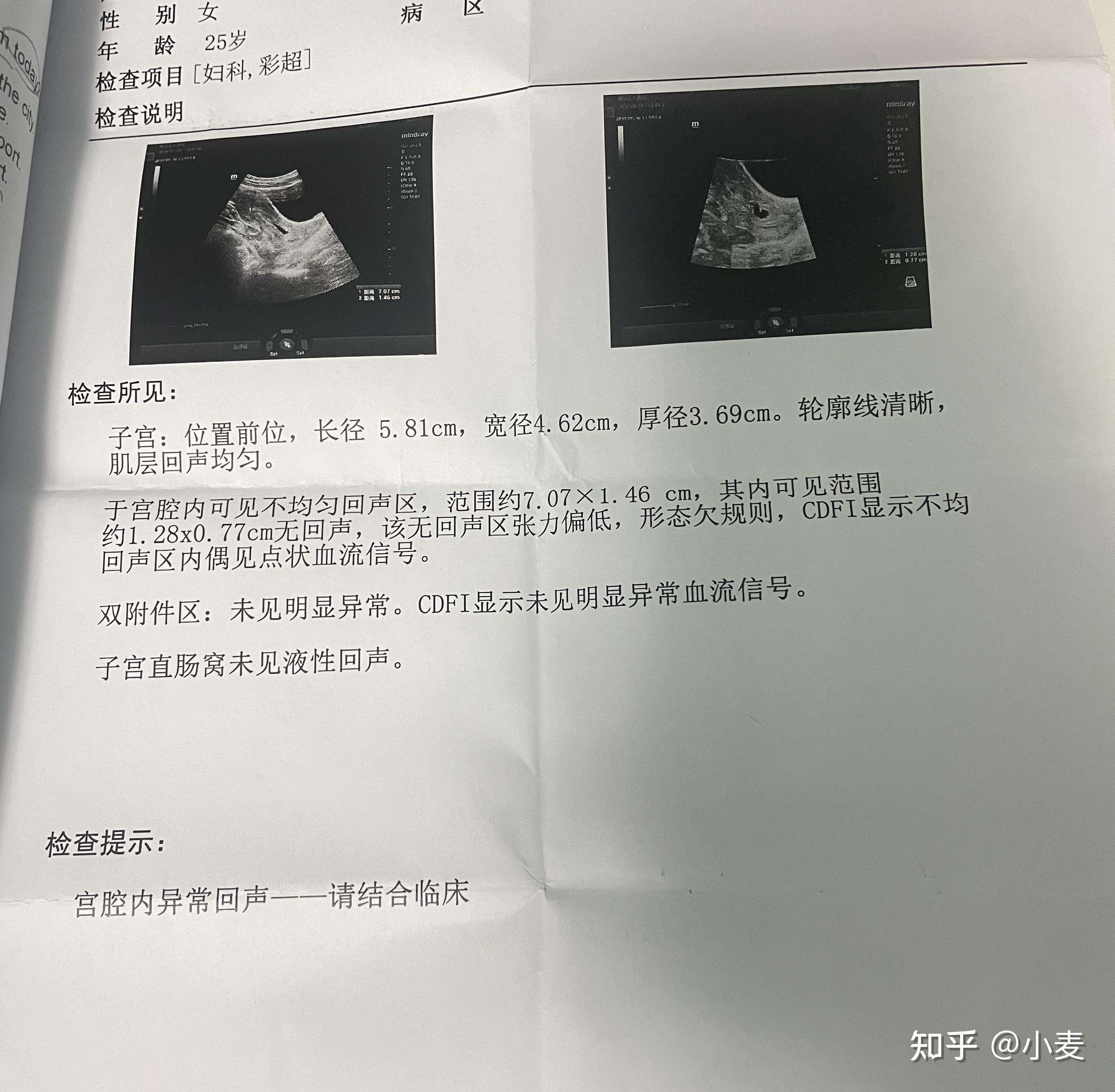 药流孕囊不掉7cm残留无清宫