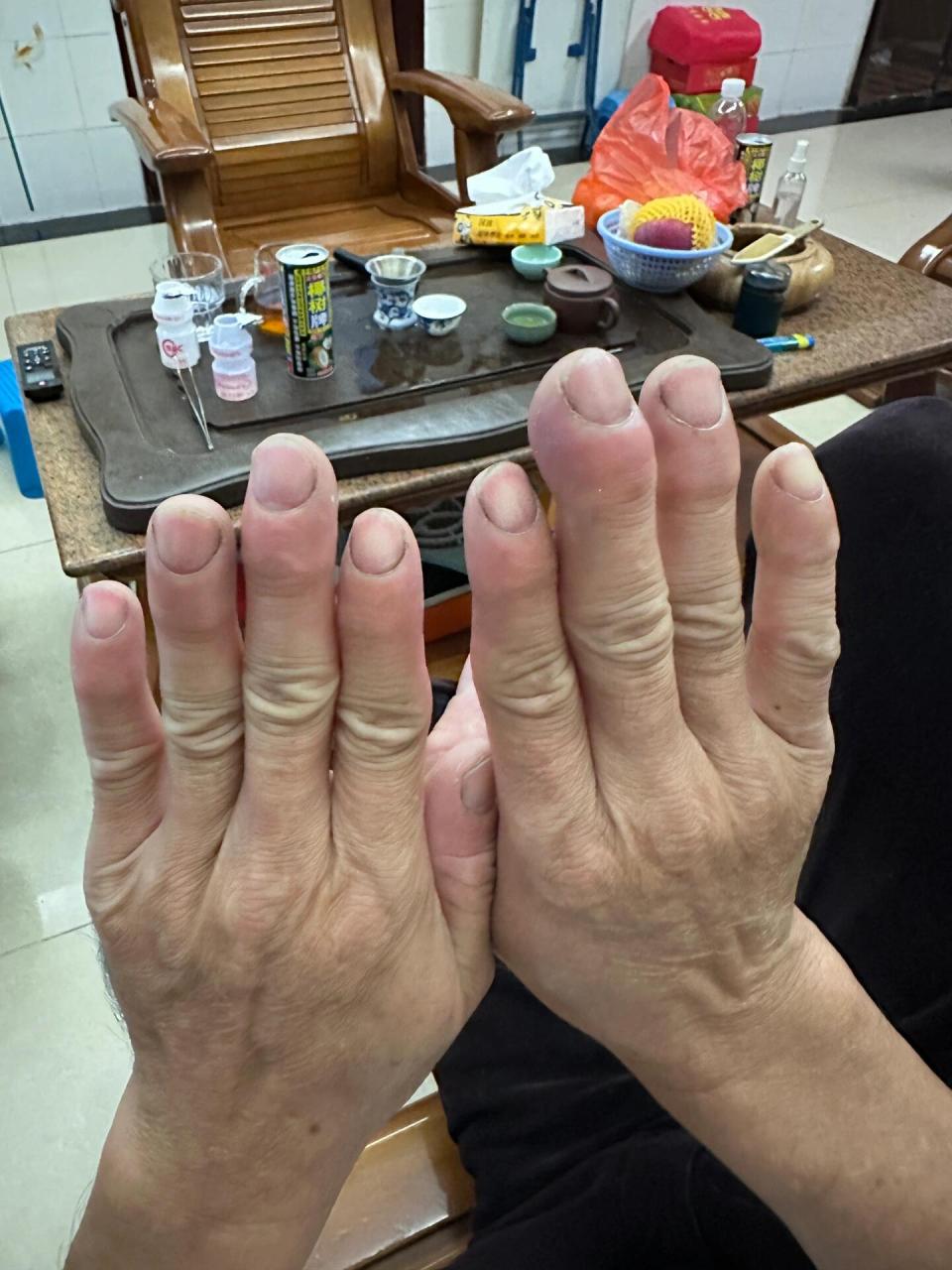 家人们,请问这是杵状指嘛?