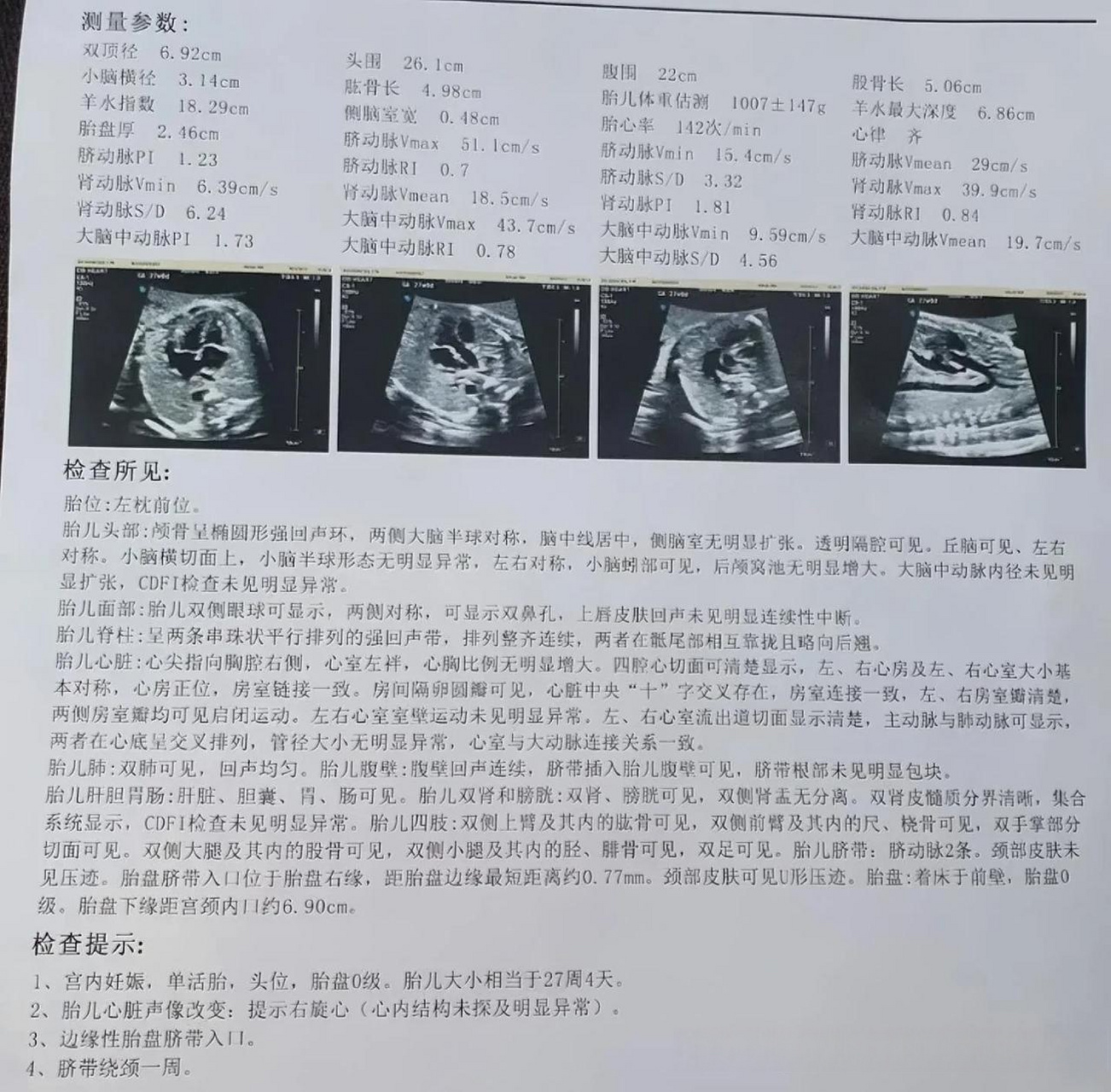 几年前,我就帮人诞下过"镜面宝宝",超声提示""右位心",芯片,染色体