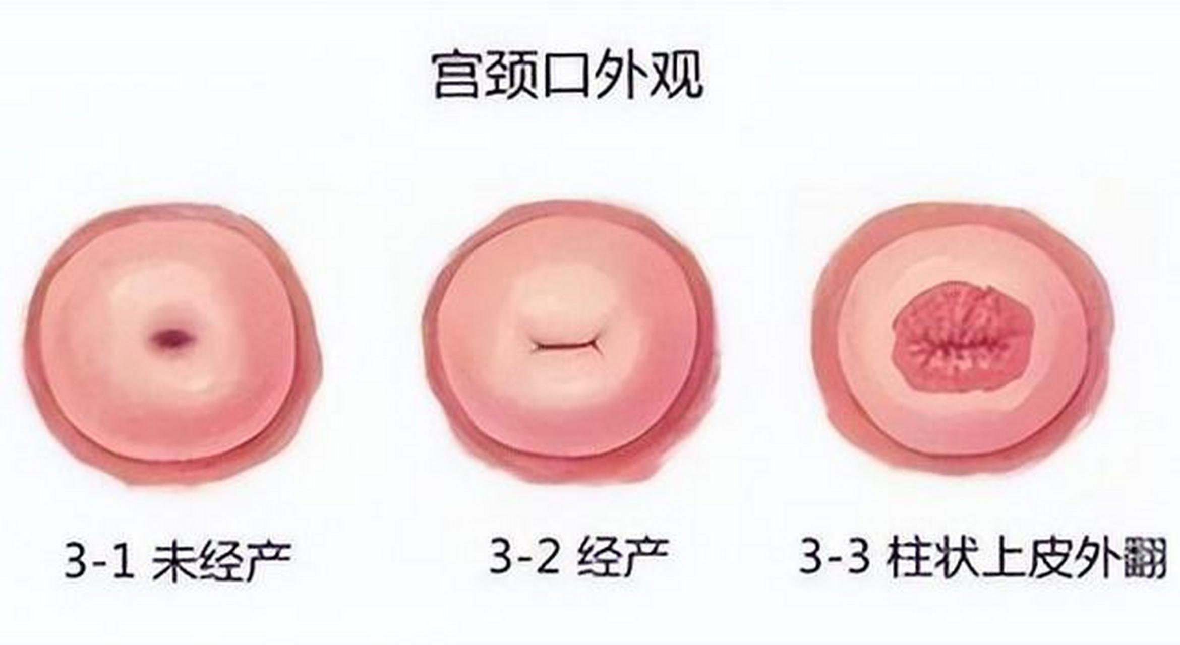 没有生育过的健康的女性宫颈口的形状为原型,宫颈口为一字型的女性