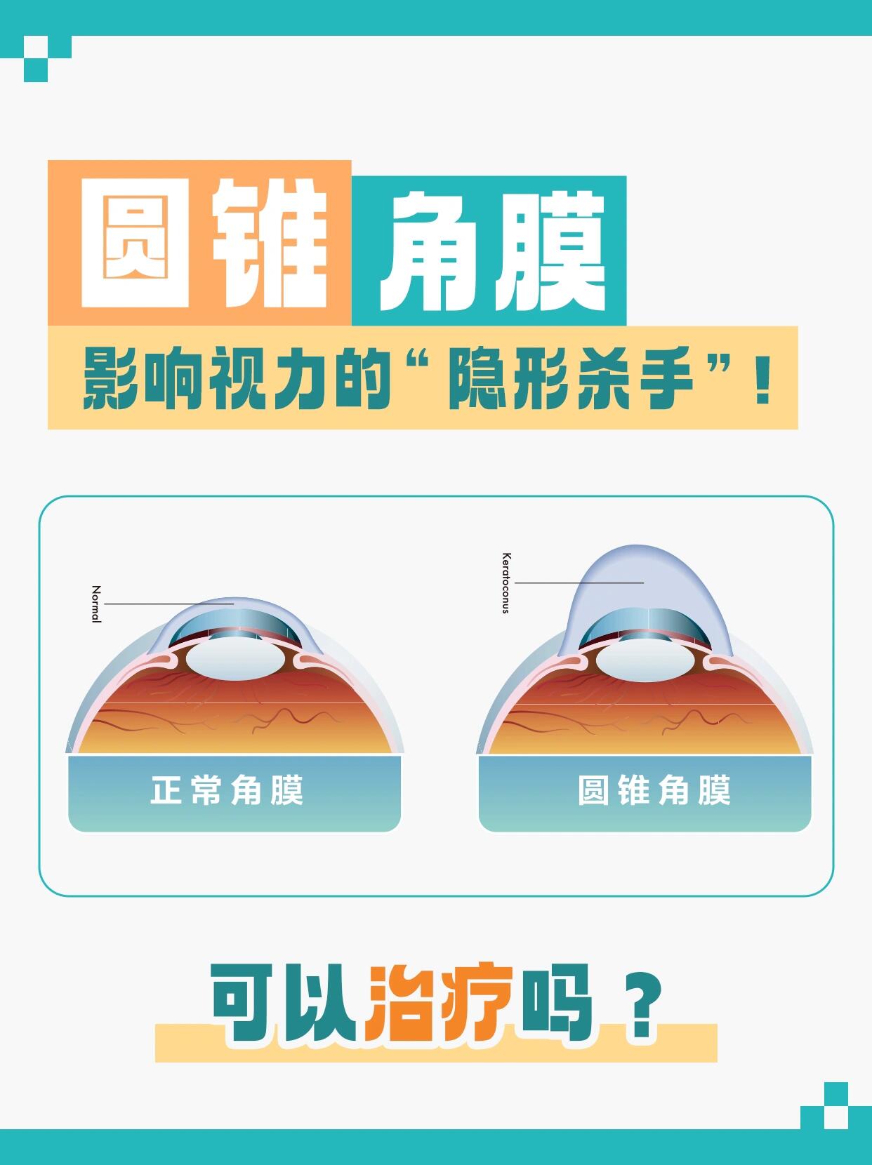 可以治疗吗 什么是圆锥角膜717171999999 	 989898