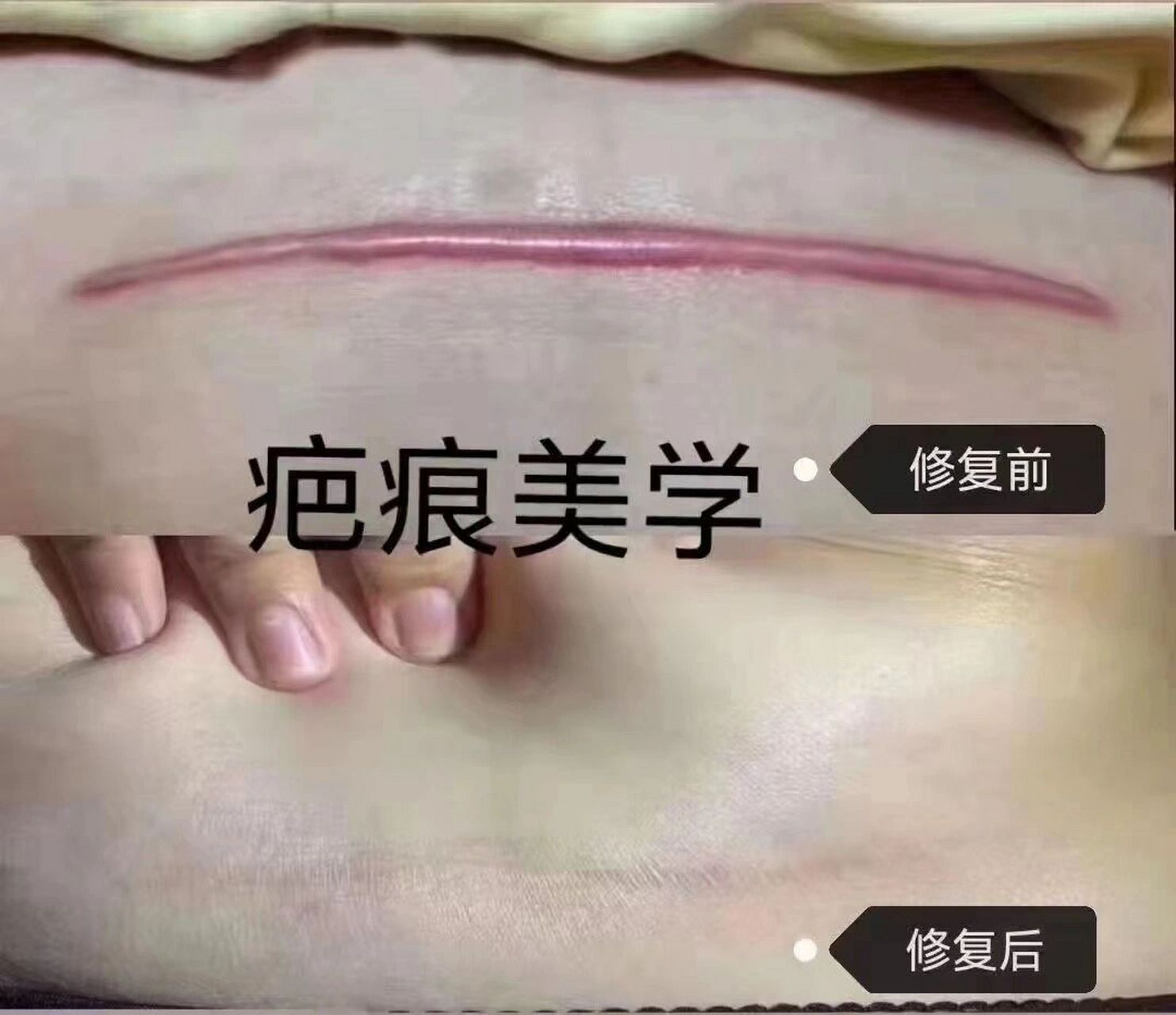 疤痕|美学 6015为什么剖宫产刀口容易增生?