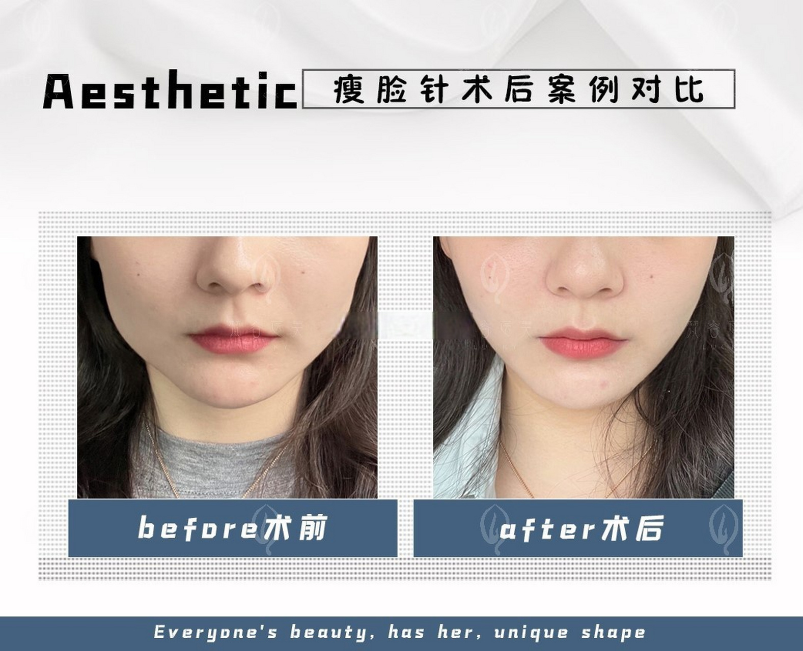 瘦咬肌# #改善脸型# 咬肌肥大造成的大小脸,可以通过打瘦脸针的方式
