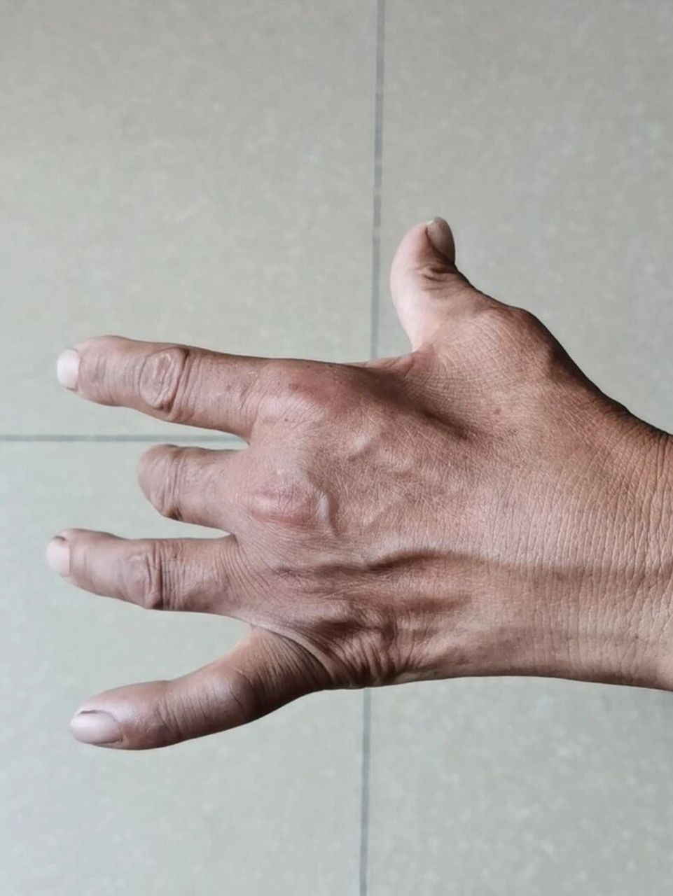 像鸡爪子一样的手,医学上有一个专有名词,叫做爪形手.