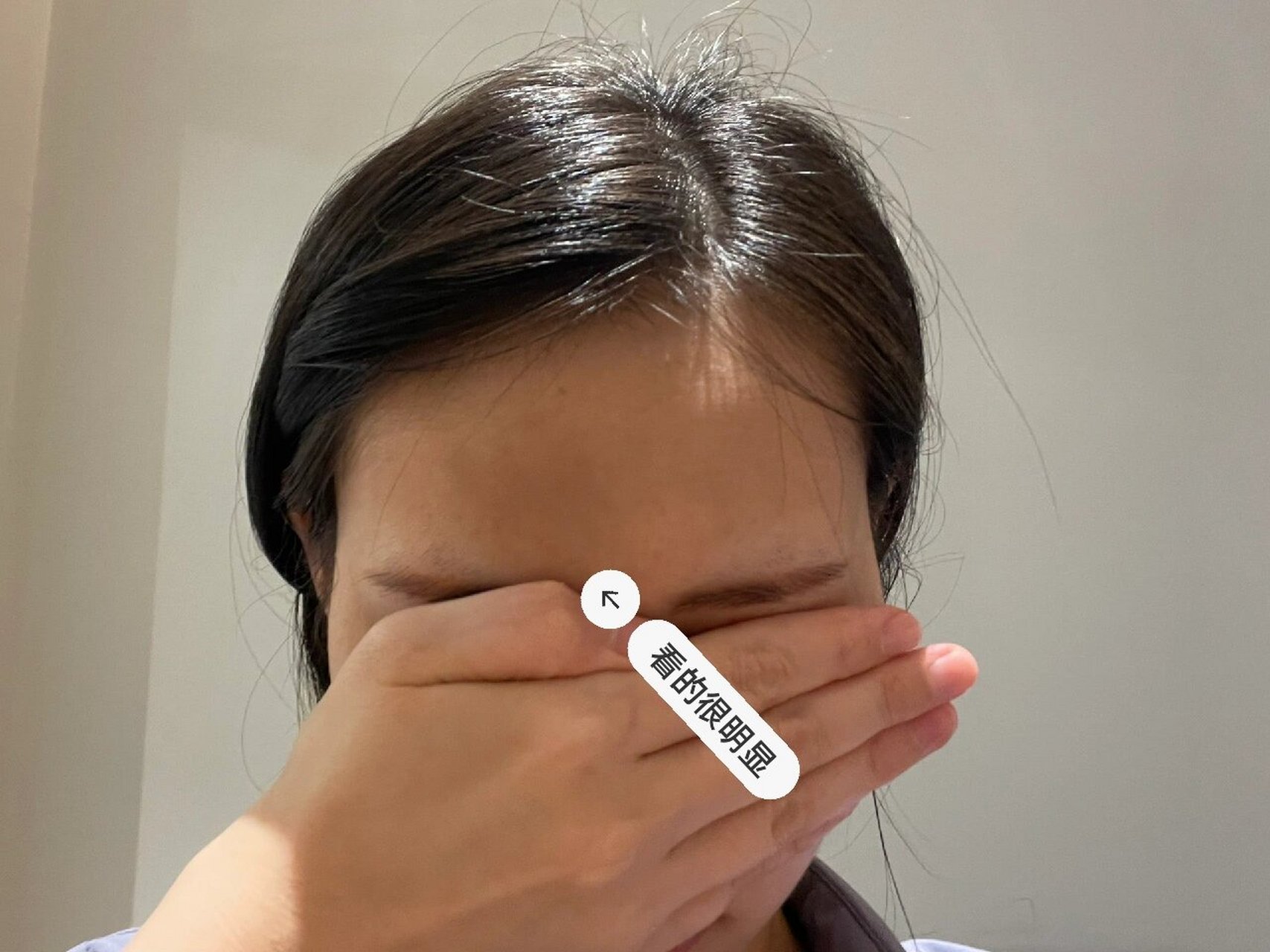 额头莫名其妙黑了一块 家人们救救我,额头黑了一块,好几个月了一直没