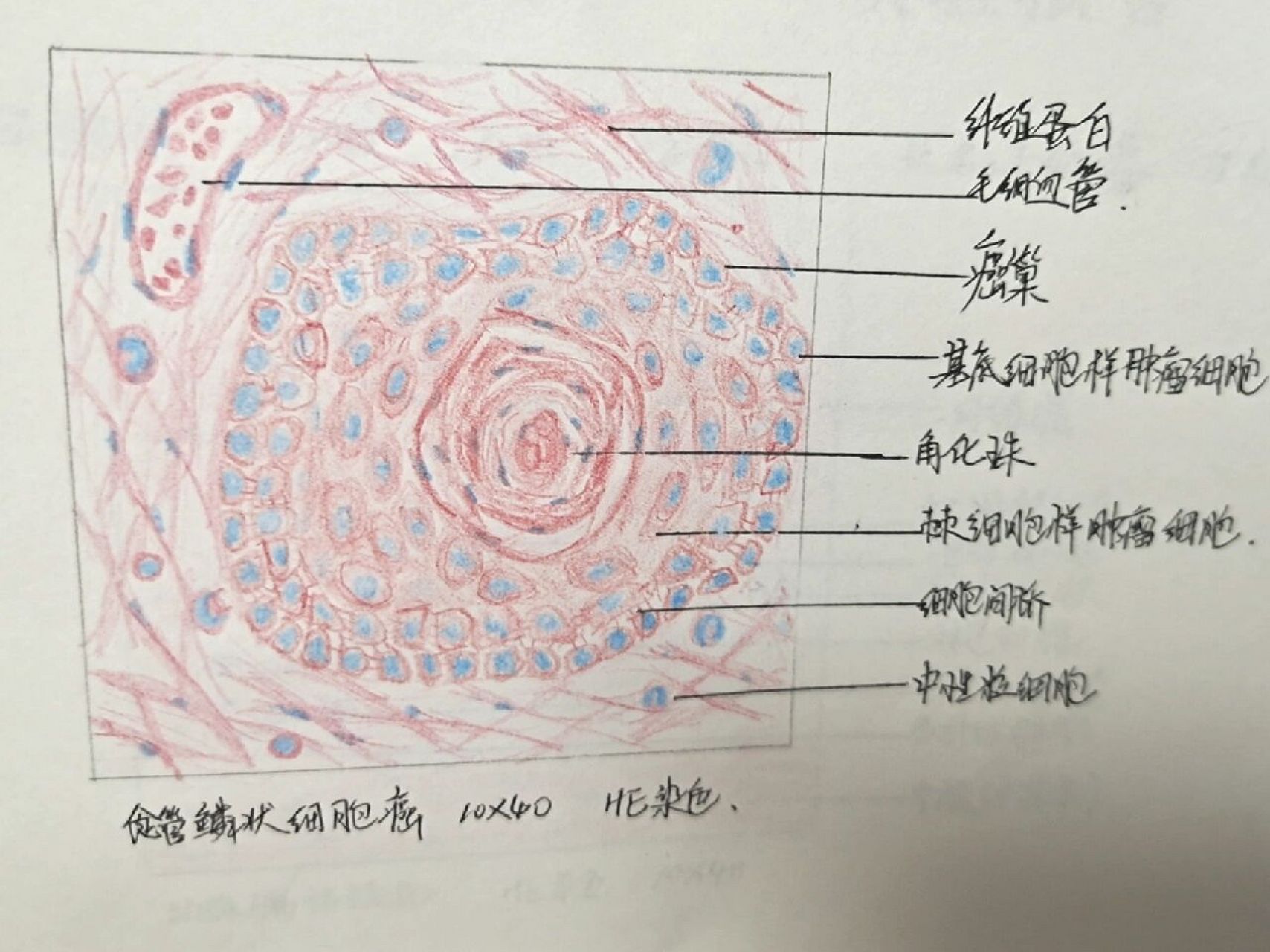 癌巢和角化珠图片图片