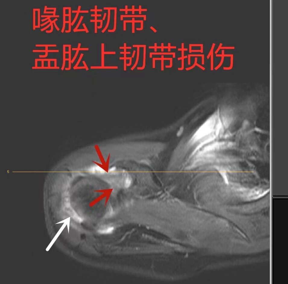 肩峰下滑囊积液图片