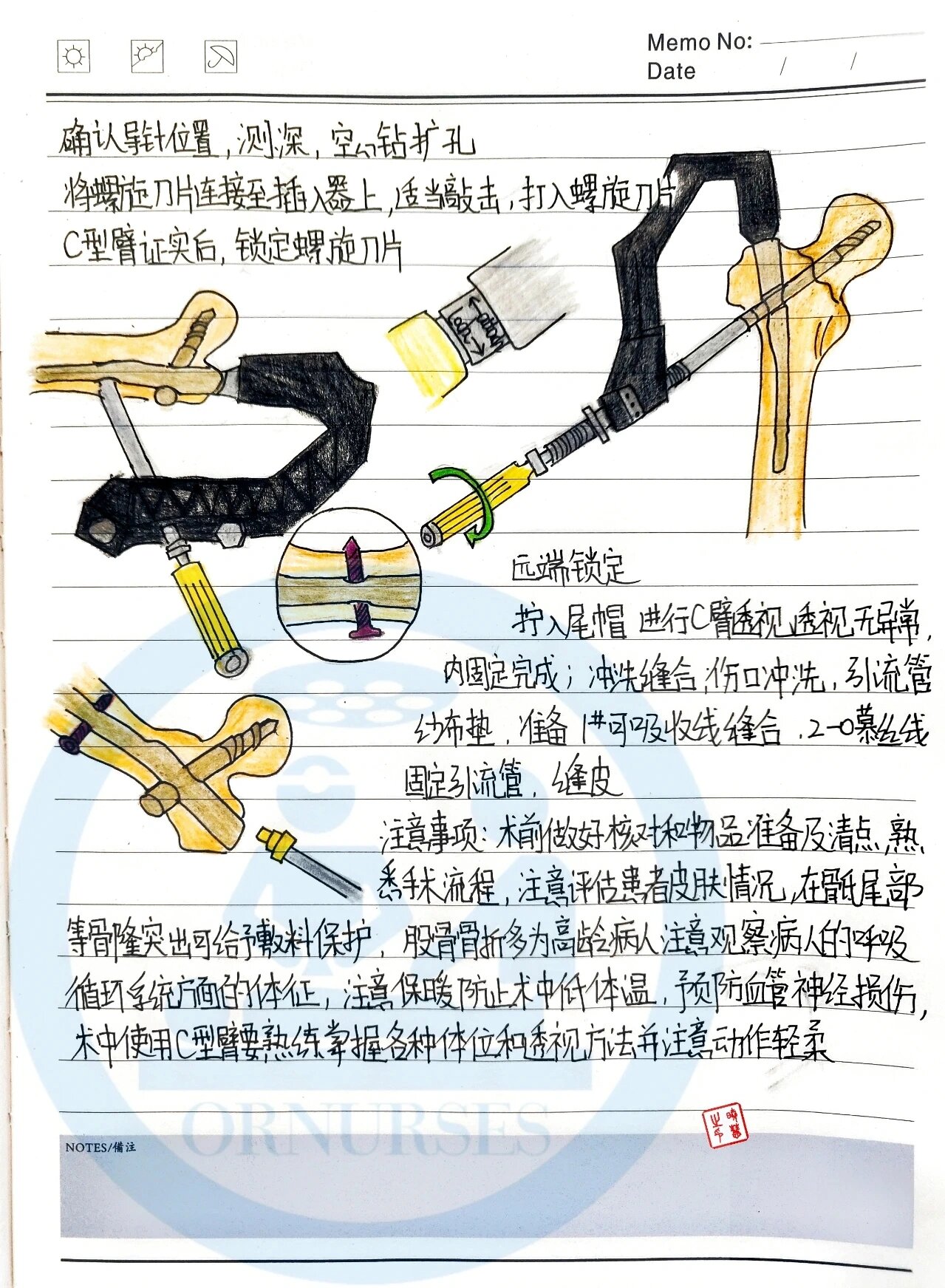 【手术笔记】pfna髓内钉手术配合