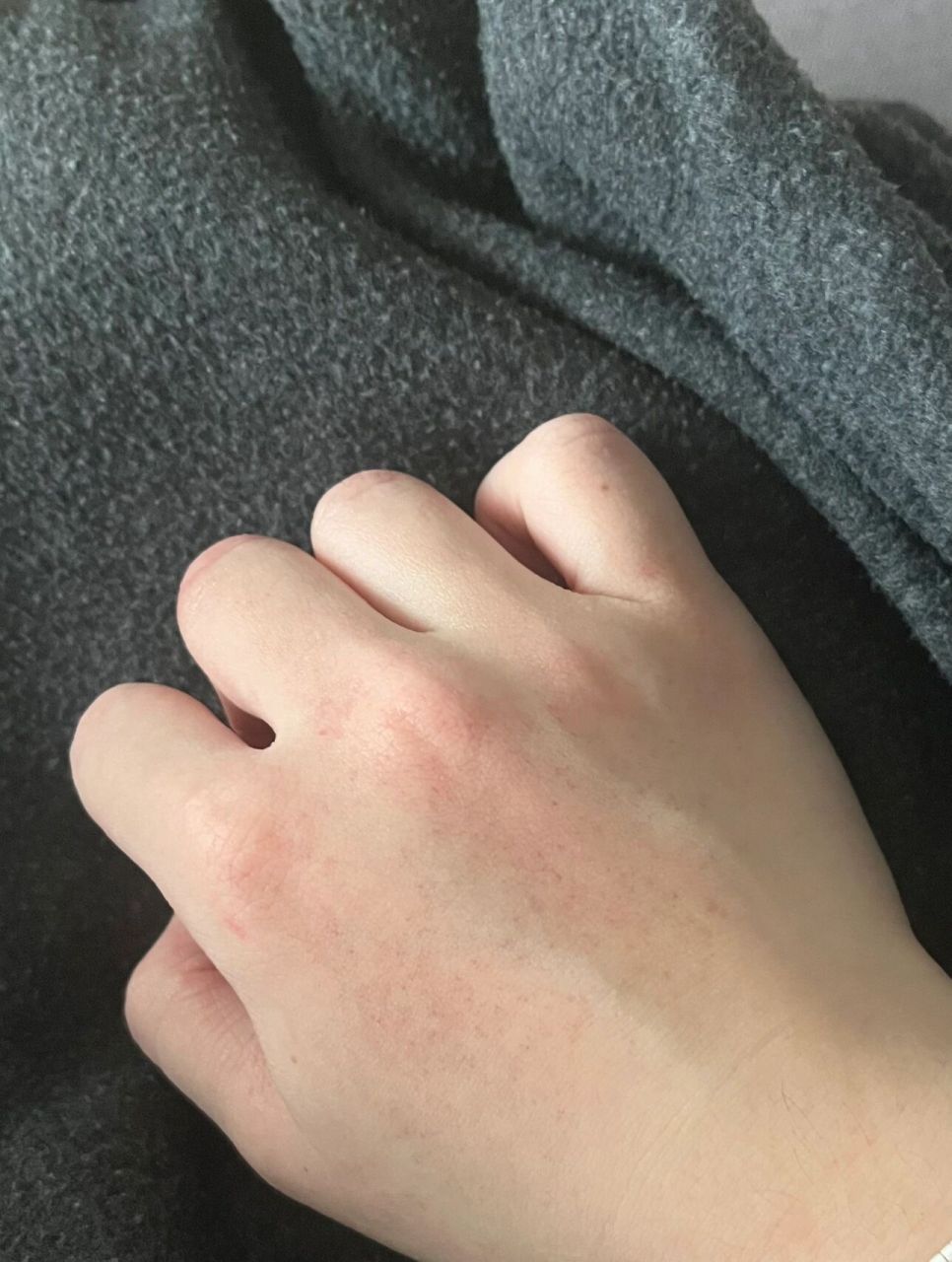 (带了猫爪助力带)回家洗完澡后发现手背起了这种小红点点…这到底是啥