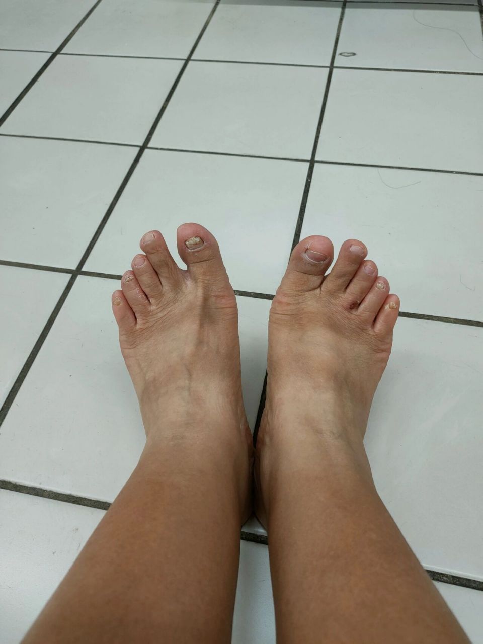 世界上最丑的脚~ 这么丑的脚,还有救嘛?