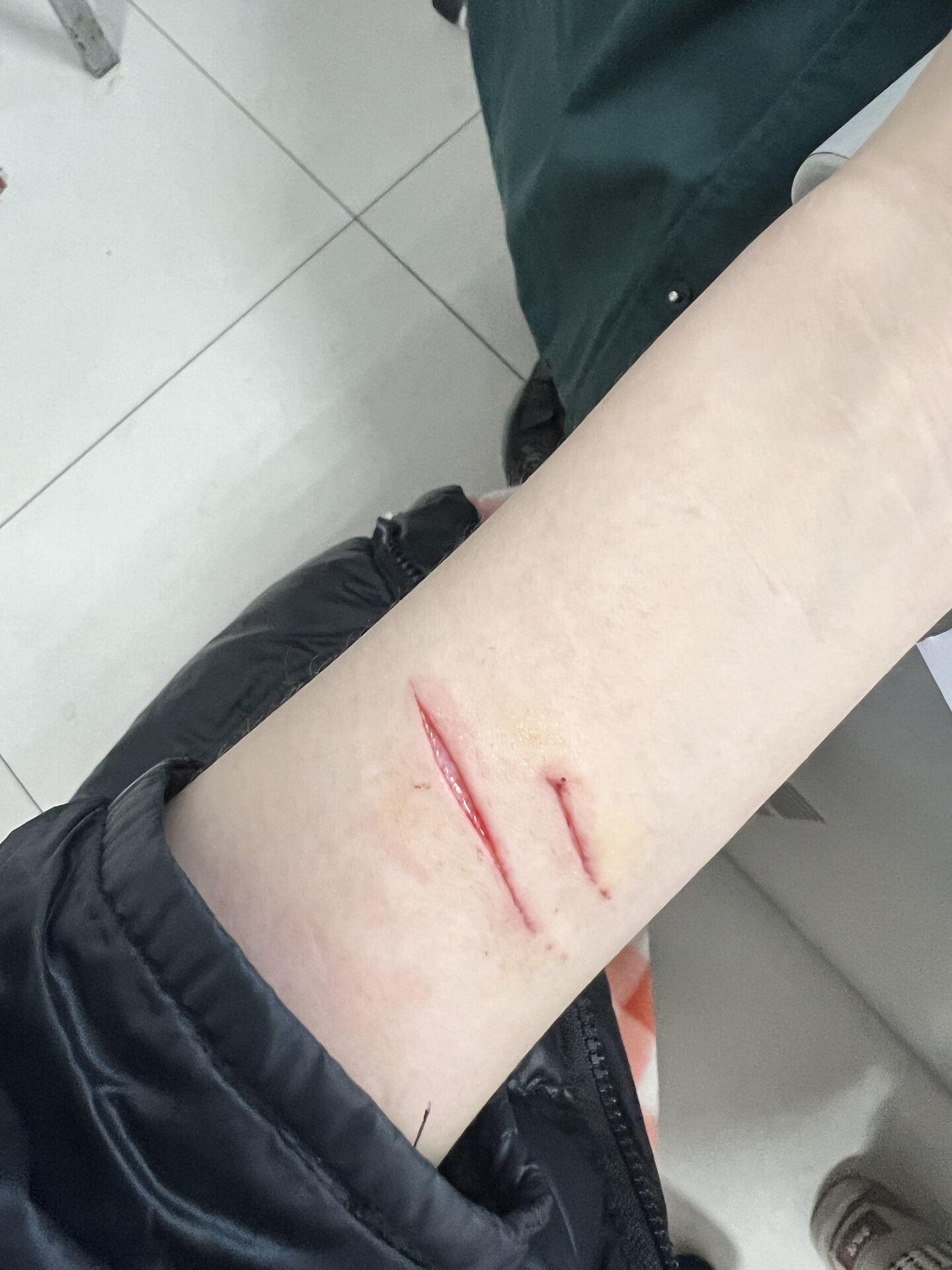 玻璃瓶子划伤 去医院清创过了 没打破伤风