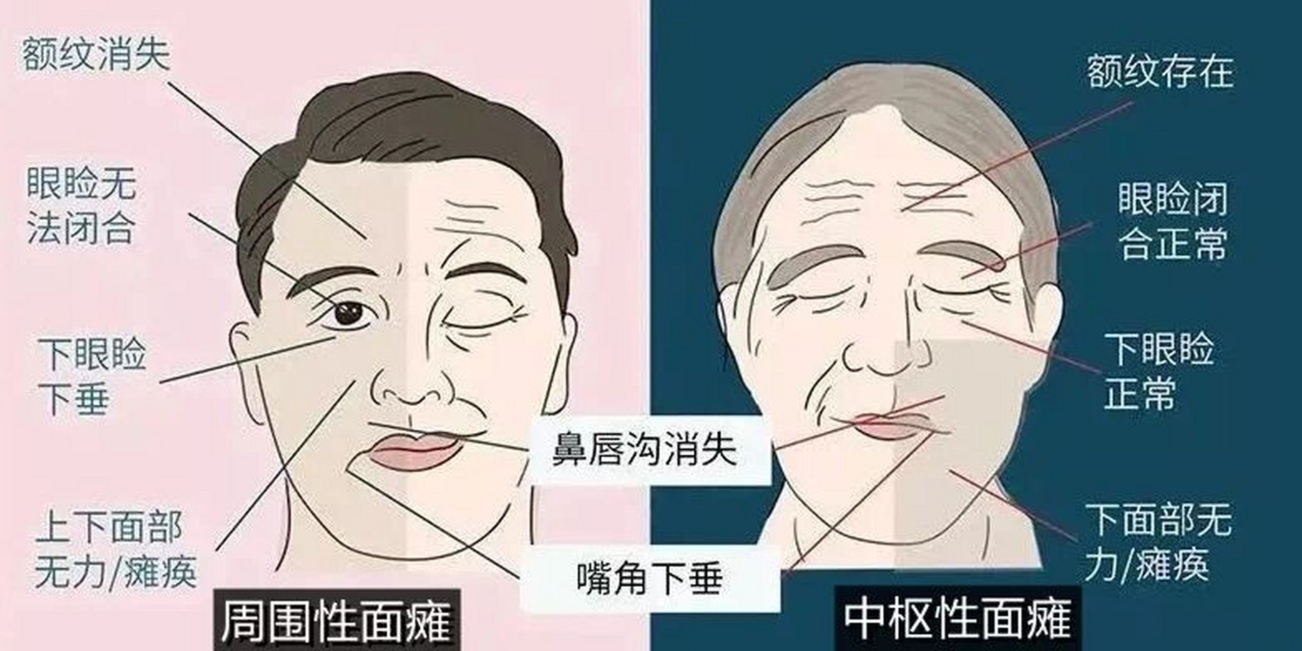 面瘫的准确位置图片图片