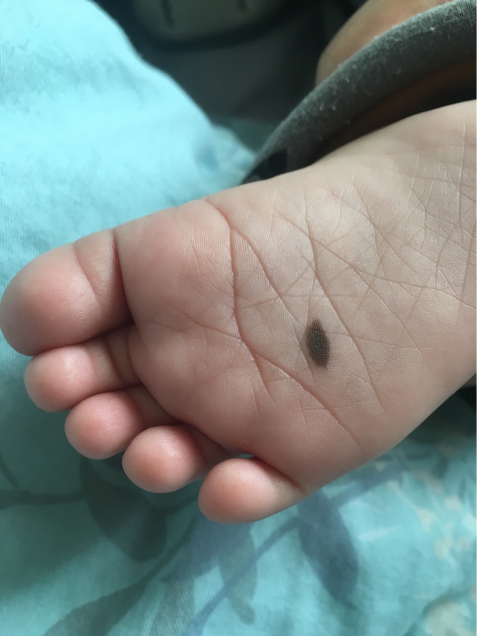 广州医生推荐 宝宝出生时脚底就长了一个痣,当时在网上刷到脚底长痣的