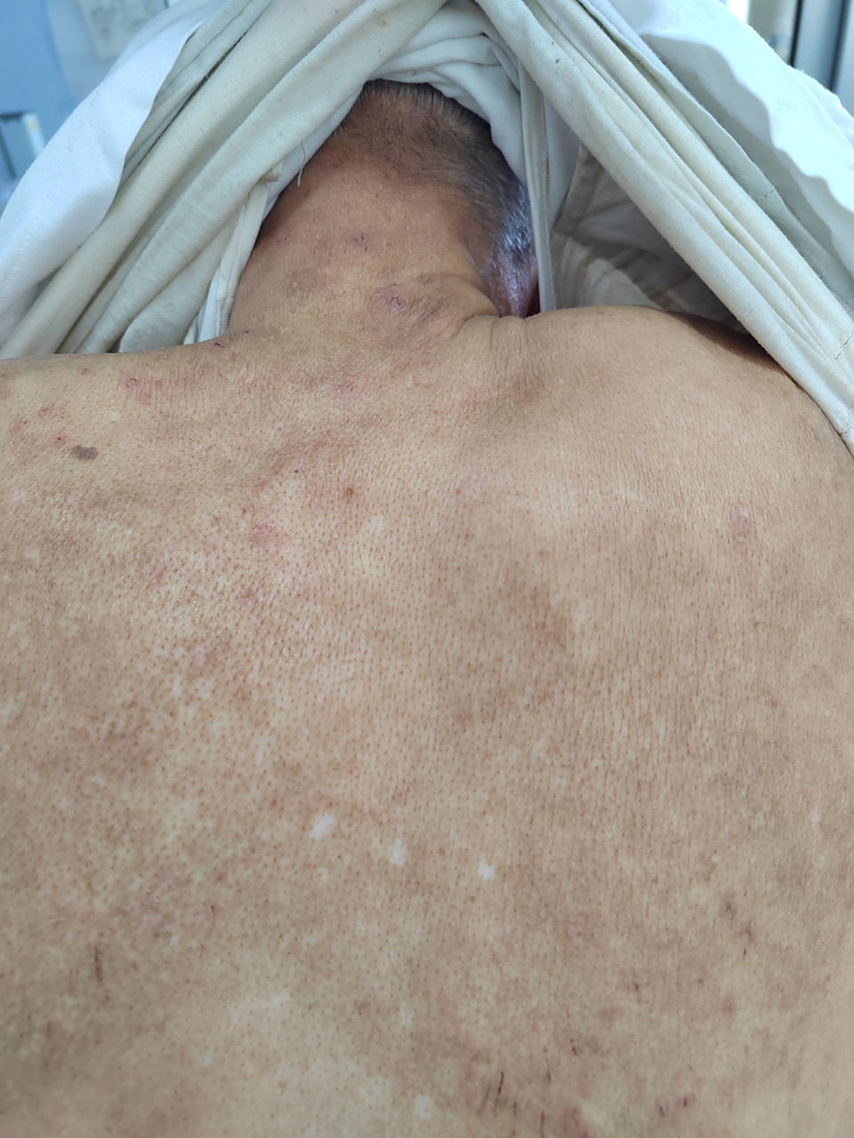 考虑特应性皮炎诊断#特应性皮炎##解决皮肤问题专注皮肤美容