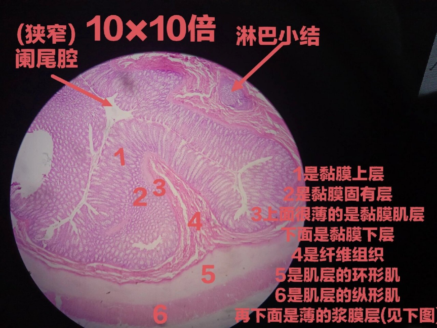 阑尾炎病理生理图图片