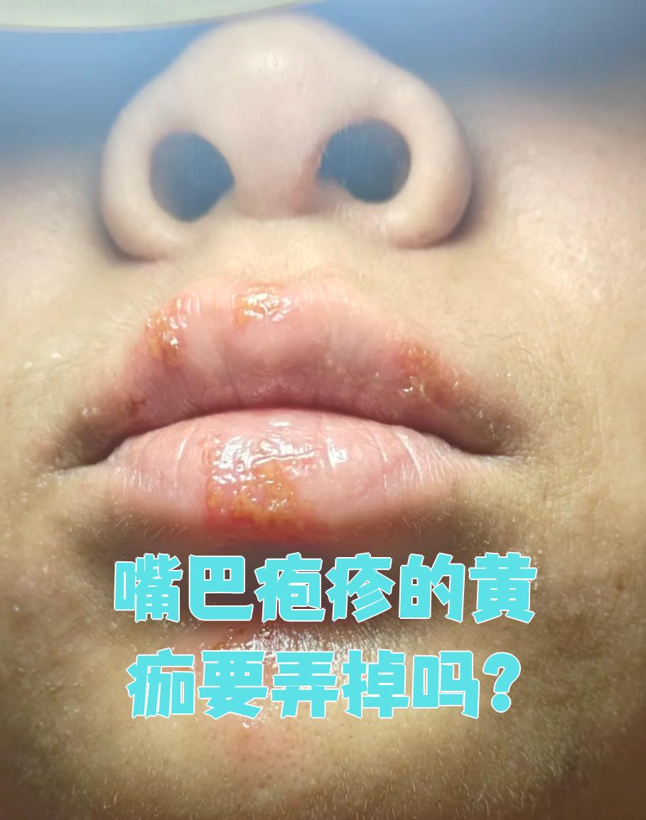 嘴巴疱疹的黄痂最好不要弄掉