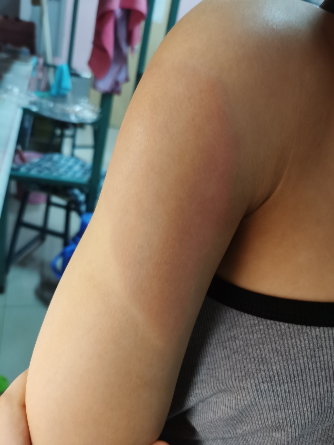 第二针新冠疫苗后过敏