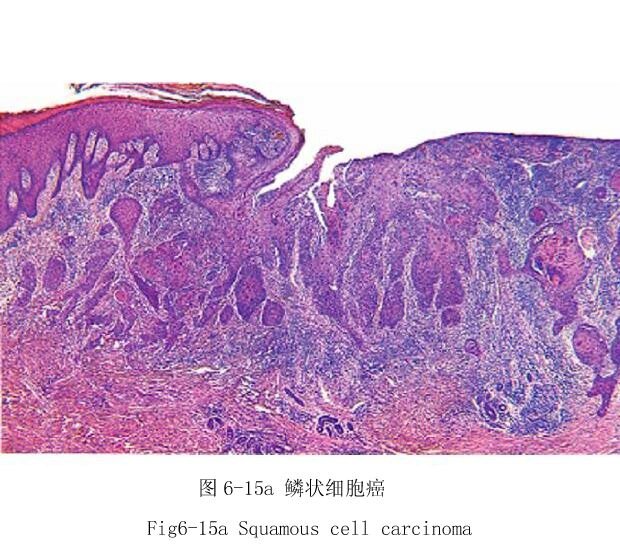 肾小管上皮细胞水肿 门脉性肝硬化 急性肺粟粒性肺结核 胃腺肠上皮